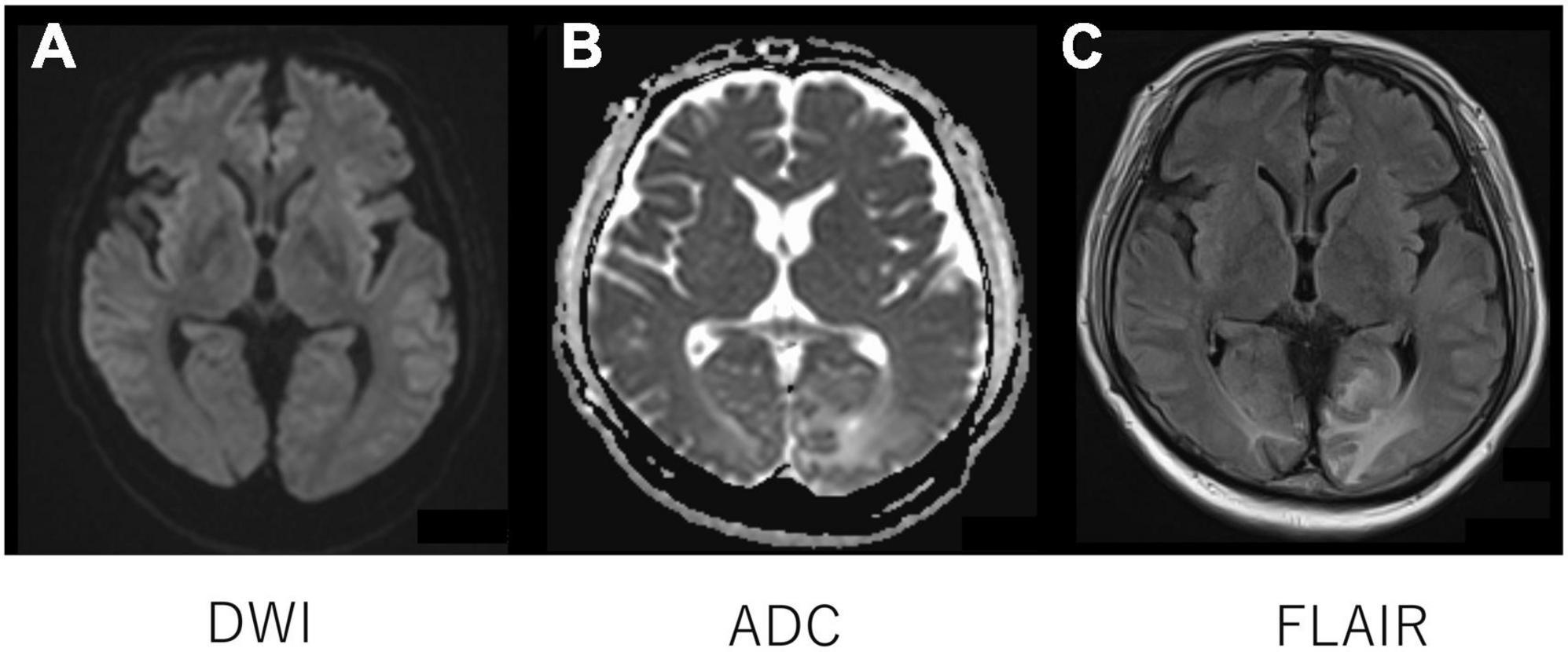 Case report: Thrombotic microangiopathy concomitant with macrophage activation syndrome in systemic lupus erythematosus refractory to conventional treatment successfully treated with eculizumab